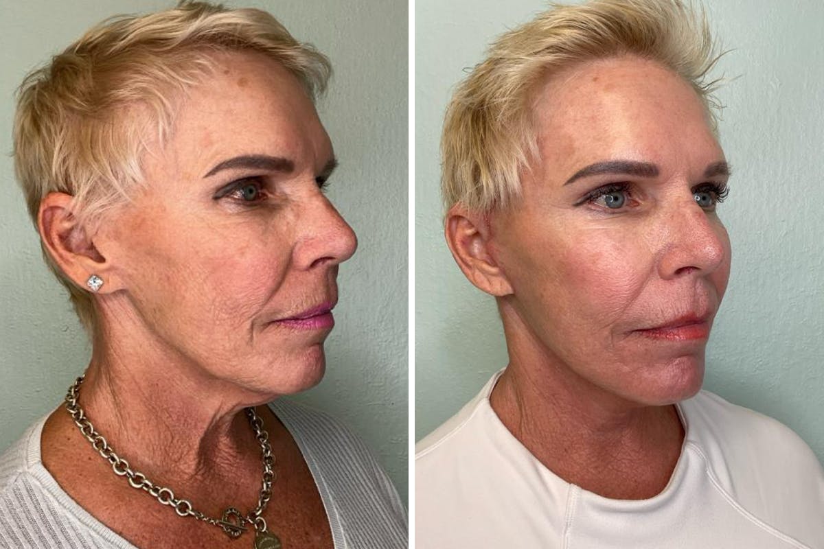 Modified Facelift Before & After Gallery - Patient 139549 - Image 2