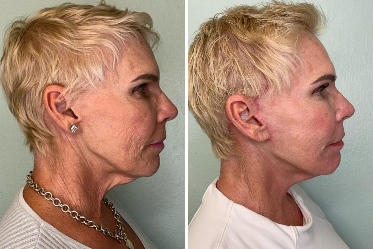 Modified Facelift Before & After Gallery - Patient 139549 - Image 3