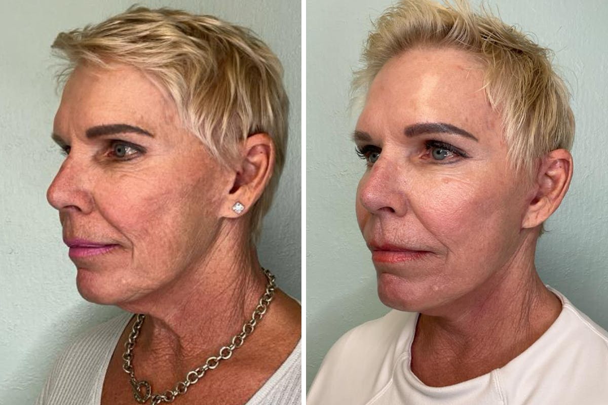 Modified Facelift Before & After Gallery - Patient 139549 - Image 4