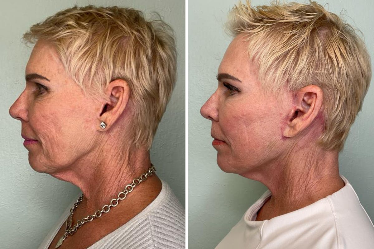 Modified Facelift Before & After Gallery - Patient 139549 - Image 5