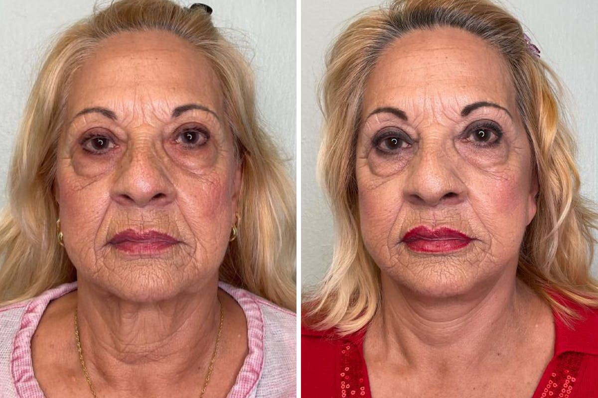 Modified Facelift Before & After Gallery - Patient 377831 - Image 1