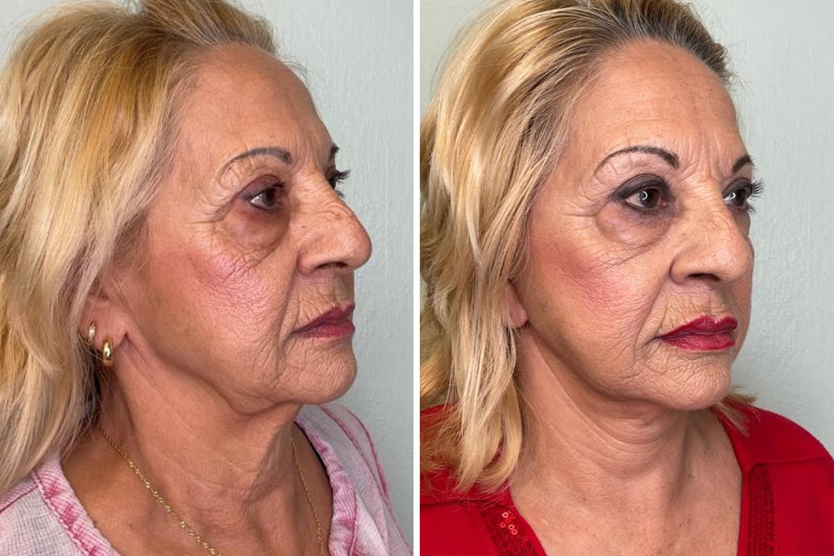 Modified Neck Lift Before & After Gallery - Patient 259538 - Image 2