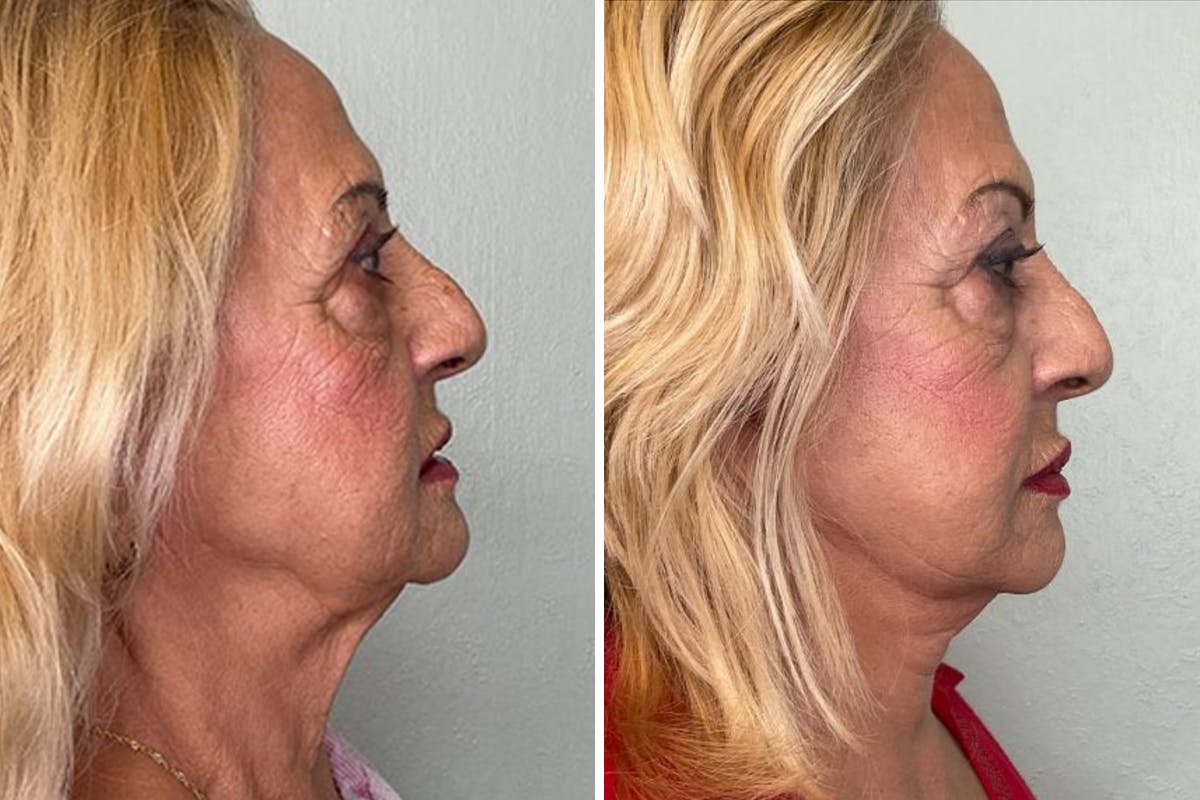 Modified Facelift Before & After Gallery - Patient 377831 - Image 3