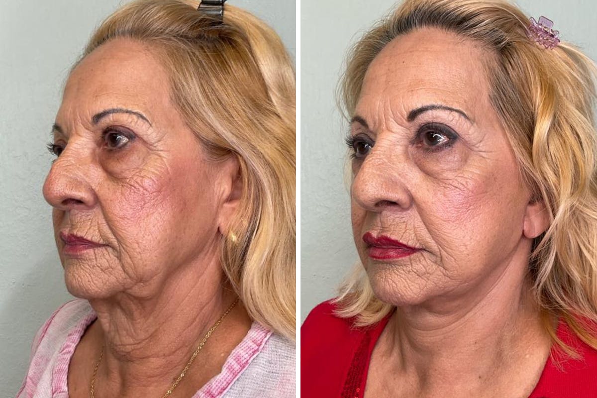 Modified Facelift Before & After Gallery - Patient 377831 - Image 4