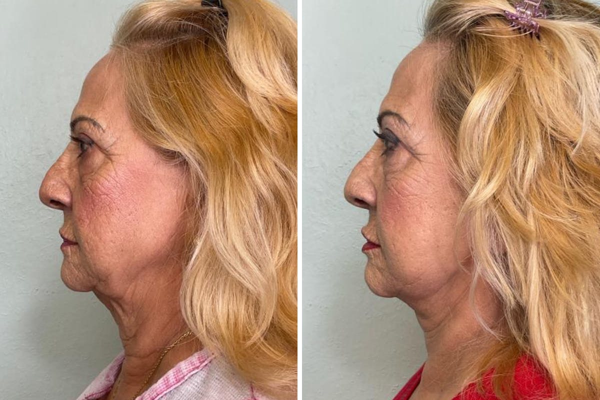 Modified Neck Lift Before & After Gallery - Patient 259538 - Image 5