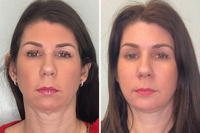 Chin Augmentation Before & After Gallery - Patient 248999 - Image 1