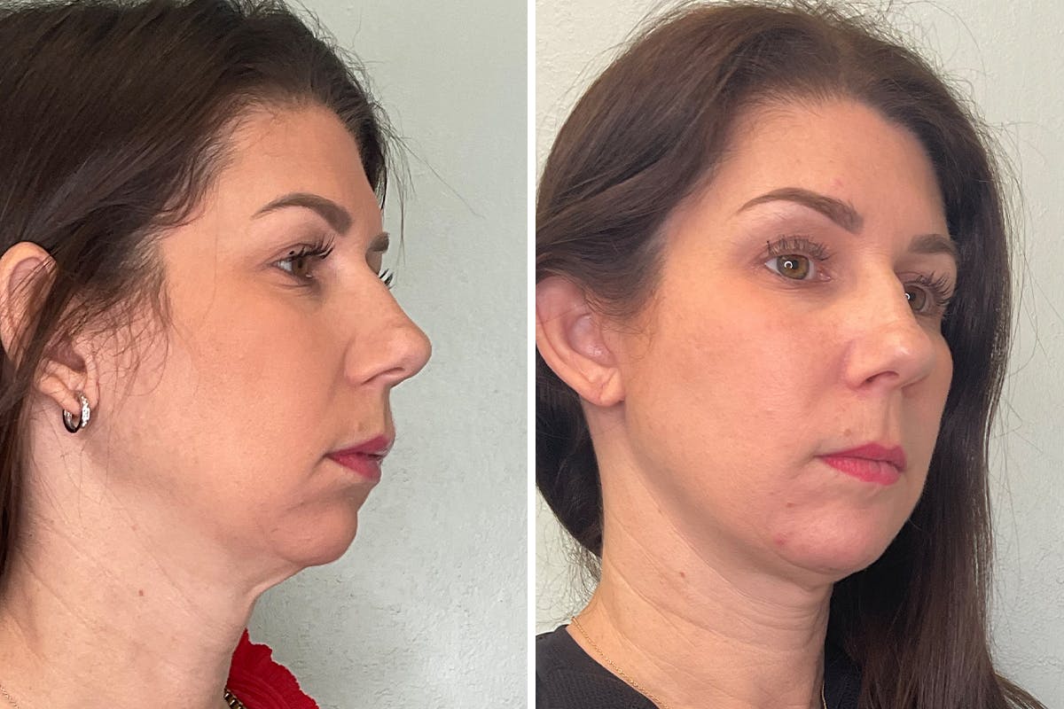 Chin Augmentation Before & After Gallery - Patient 248999 - Image 2