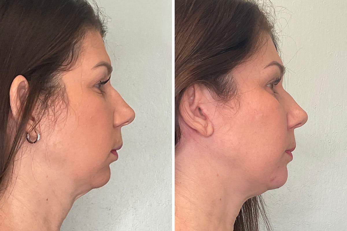 Chin Augmentation Before & After Gallery - Patient 248999 - Image 3