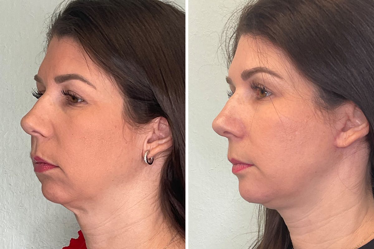 Chin Augmentation Before & After Gallery - Patient 248999 - Image 4