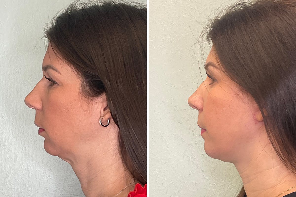 Chin Augmentation Before & After Gallery - Patient 248999 - Image 5