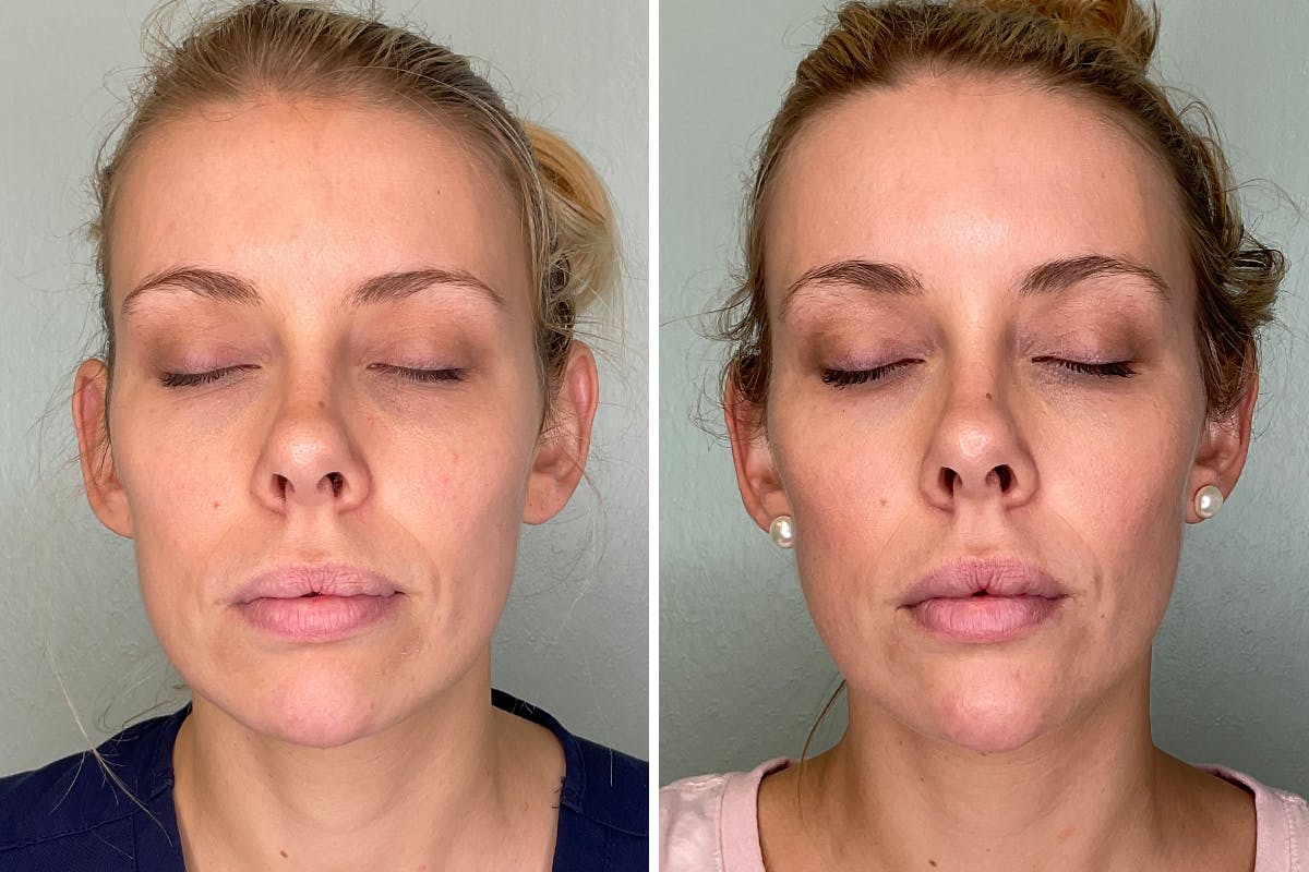 Chin Augmentation Before & After Gallery - Patient 364502 - Image 1