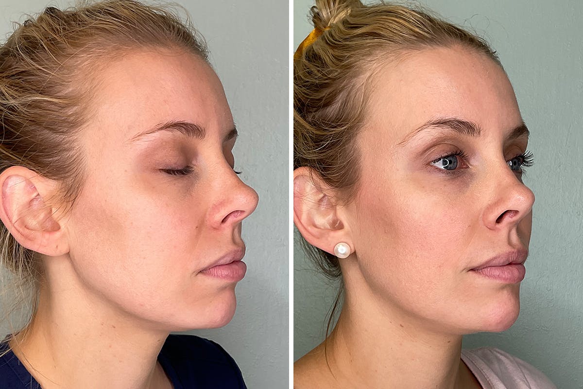 Chin Augmentation Before & After Gallery - Patient 364502 - Image 2
