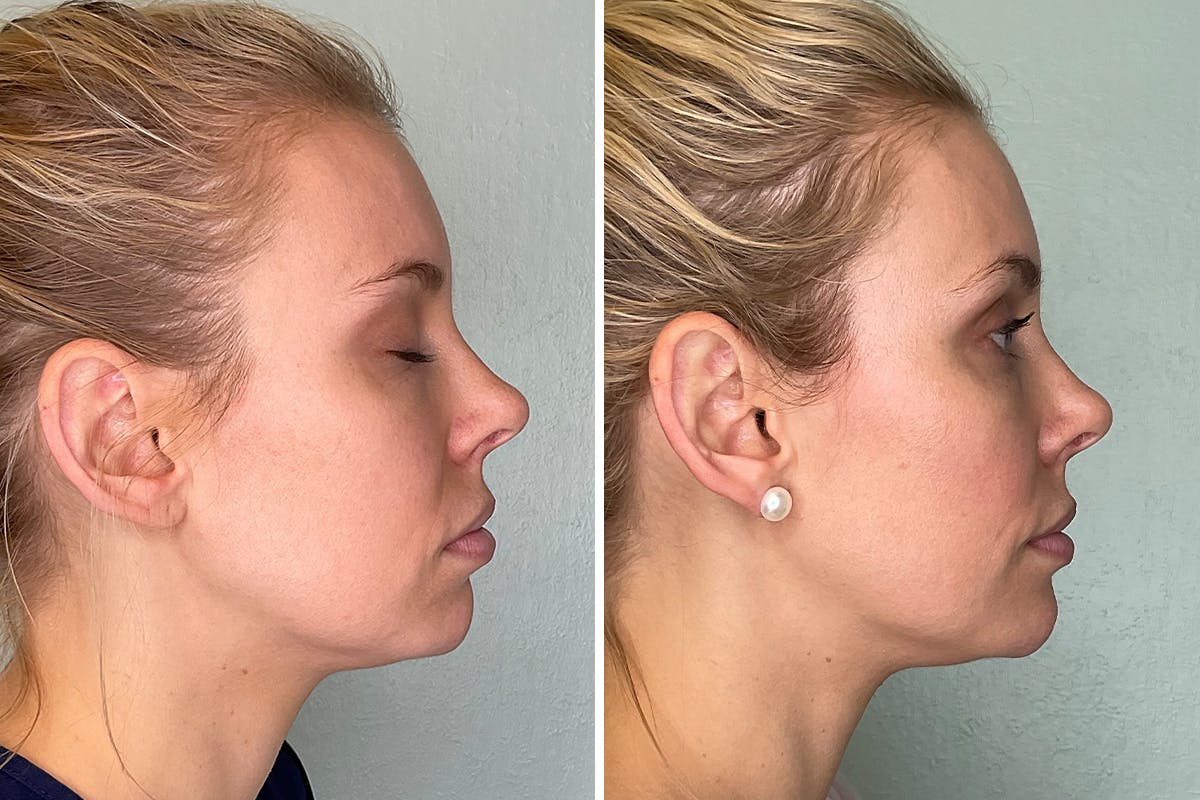 Chin Augmentation Before & After Gallery - Patient 364502 - Image 3