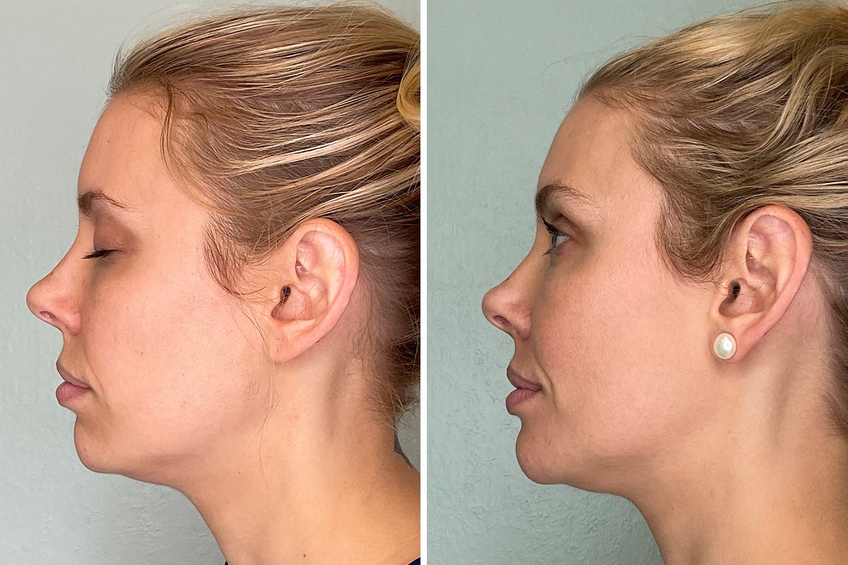Chin Augmentation Before & After Gallery - Patient 364502 - Image 5