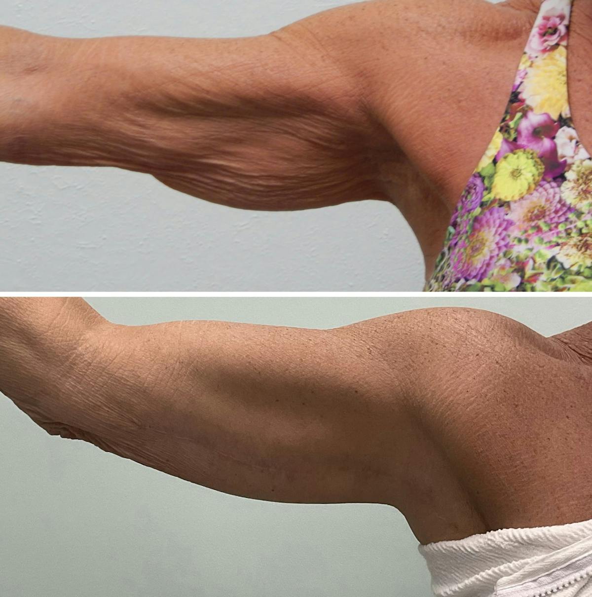 Arm Lift Before & After Gallery - Patient 219154 - Image 1