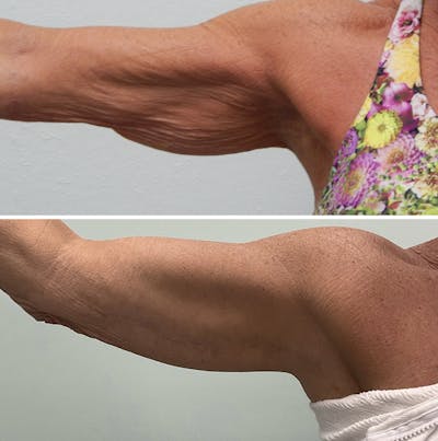 Arm Lift Before & After Gallery - Patient 219154 - Image 1