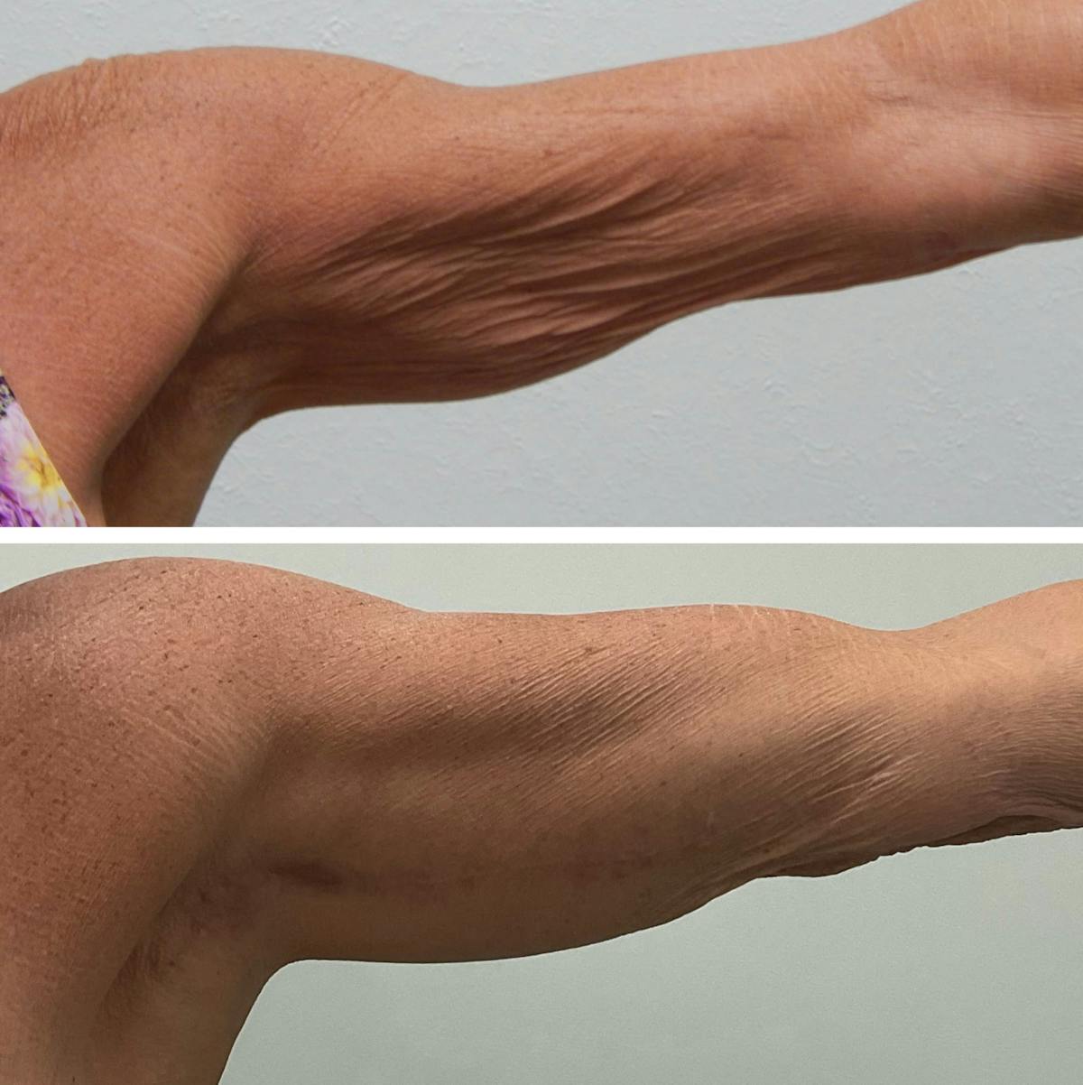 Arm Lift Before & After Gallery - Patient 219154 - Image 2
