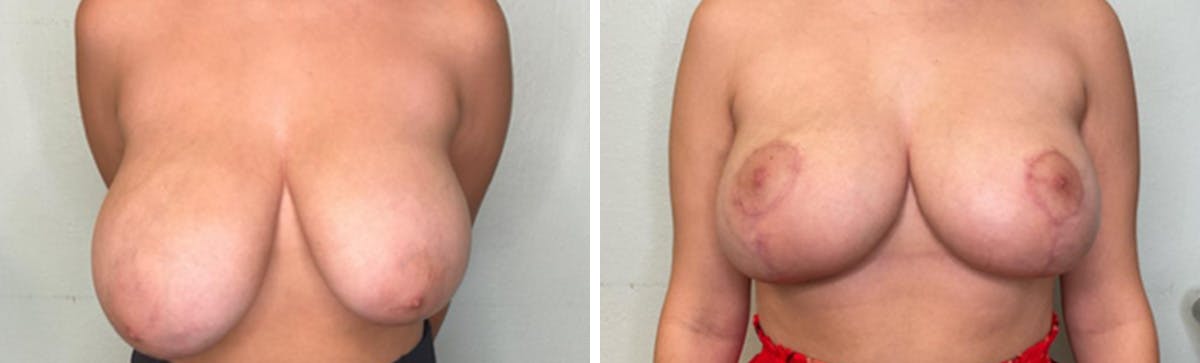 Breast Lift Before & After Gallery - Patient 354462 - Image 1