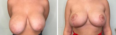 Breast Lift Before & After Gallery - Patient 354462 - Image 1