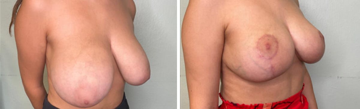 Breast Lift Before & After Gallery - Patient 354462 - Image 2