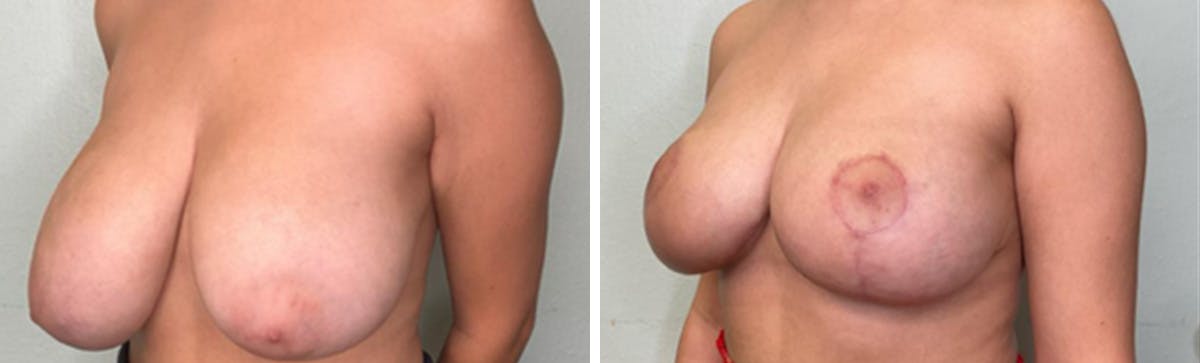 Breast Lift Before & After Gallery - Patient 354462 - Image 4