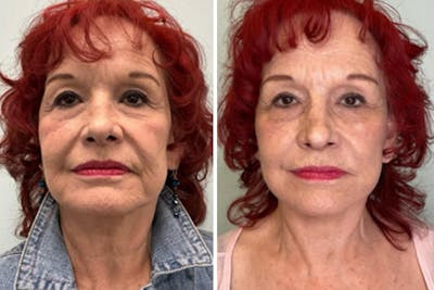 Modified Neck Lift Before & After Gallery - Patient 198576 - Image 1
