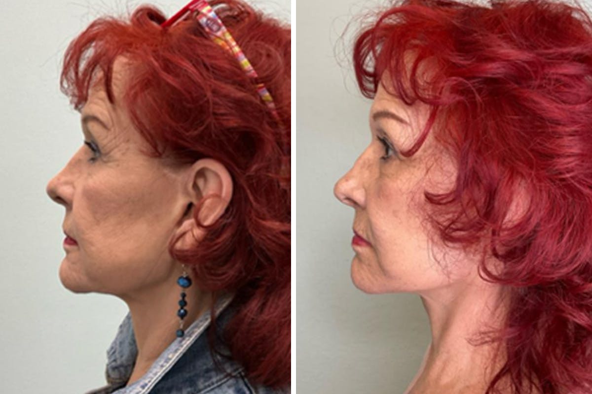 Modified Neck Lift Before & After Gallery - Patient 198576 - Image 5