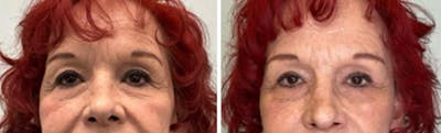 Eyelid Surgery Before & After Gallery - Patient 300864 - Image 1