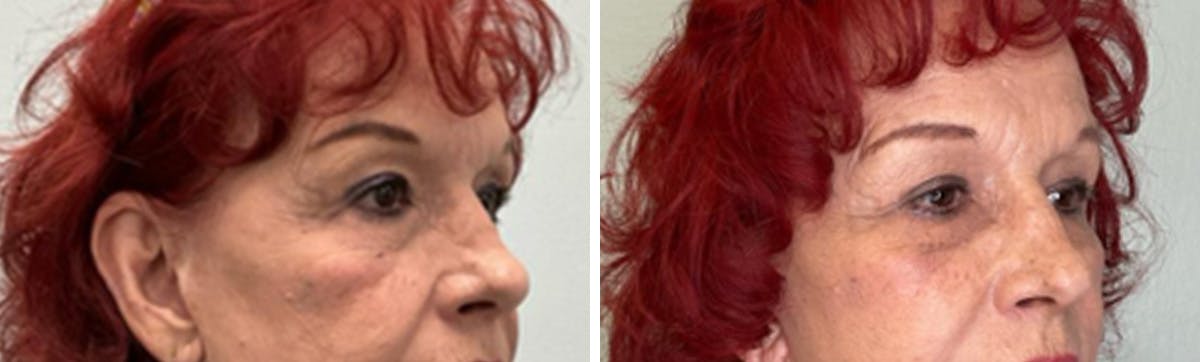 Eyelid Surgery Before & After Gallery - Patient 300864 - Image 2
