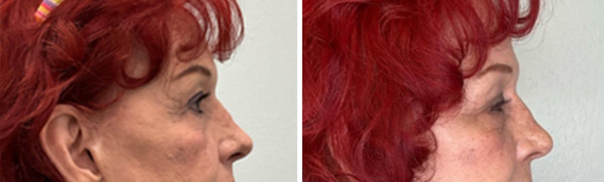 Eyelid Surgery Before & After Gallery - Patient 300864 - Image 3