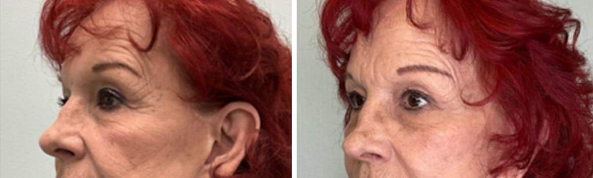 Eyelid Surgery Before & After Gallery - Patient 300864 - Image 4