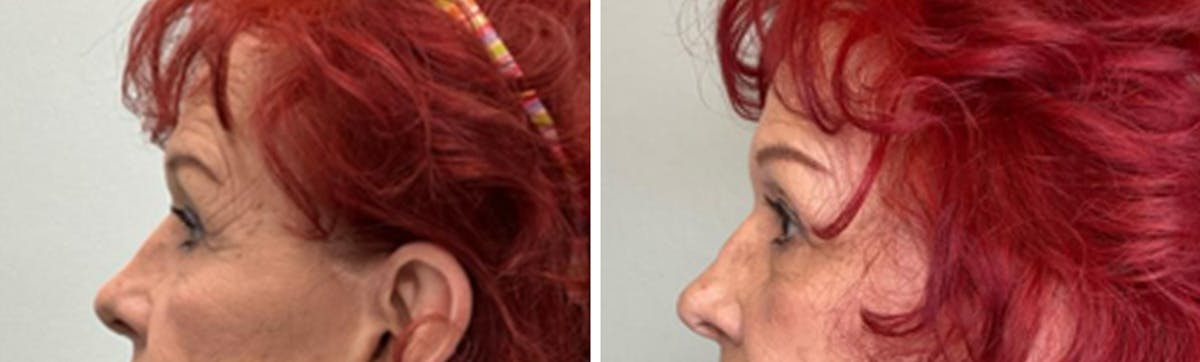 Eyelid Surgery Before & After Gallery - Patient 300864 - Image 5