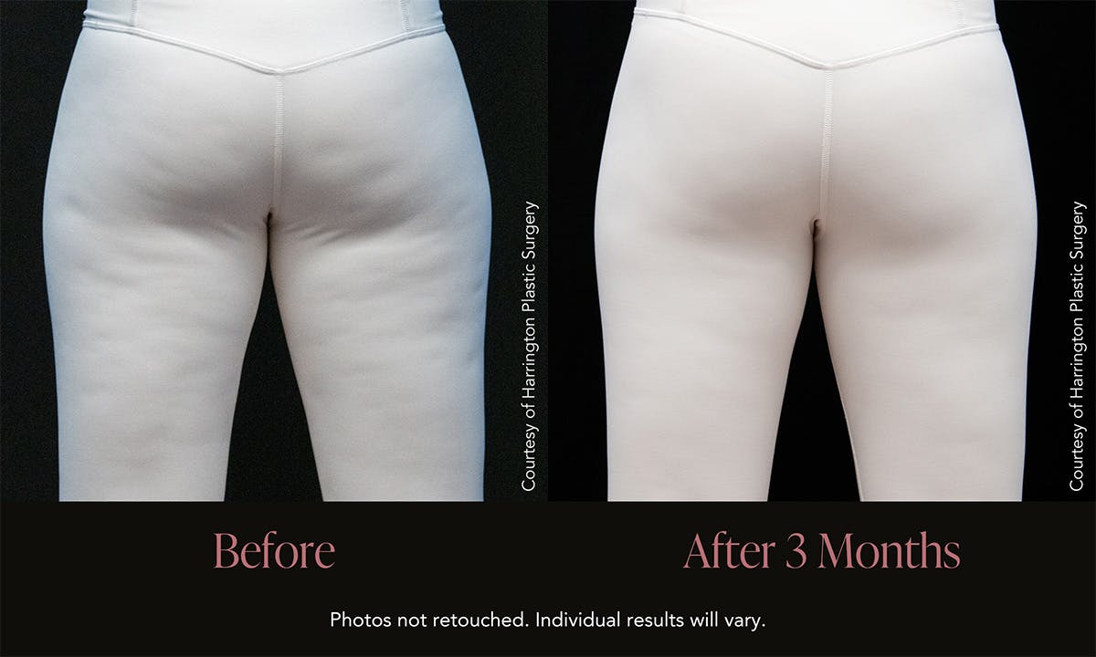 Avéli Before & After Gallery - Patient 144820 - Image 1