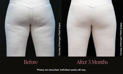 Avéli Before & After Gallery - Patient 144820 - Image 1