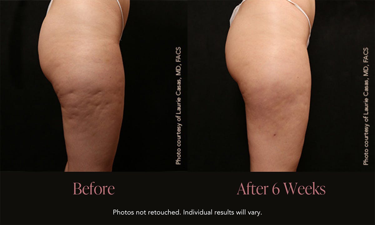 Avéli Before & After Gallery - Patient 392724 - Image 1
