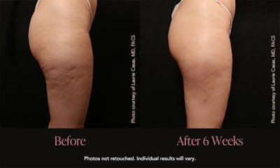 Avéli Before & After Gallery - Patient 392724 - Image 1