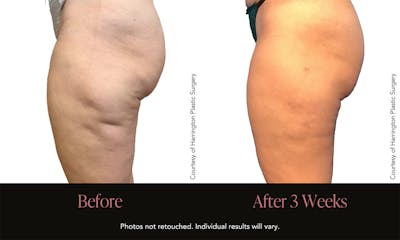 Avéli Before & After Gallery - Patient 300627 - Image 1