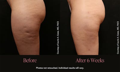 Avéli Before & After Gallery - Patient 399809 - Image 1