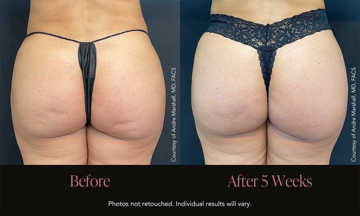 Avéli Before & After Gallery - Patient 234977 - Image 1