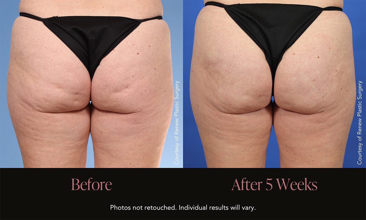 Avéli Before & After Gallery - Patient 120979 - Image 1