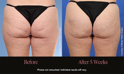 Avéli Before & After Gallery - Patient 120979 - Image 1