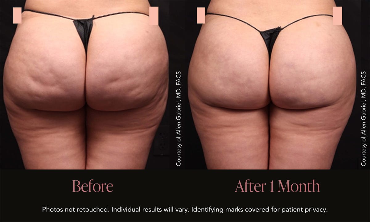 Avéli Before & After Gallery - Patient 355951 - Image 1