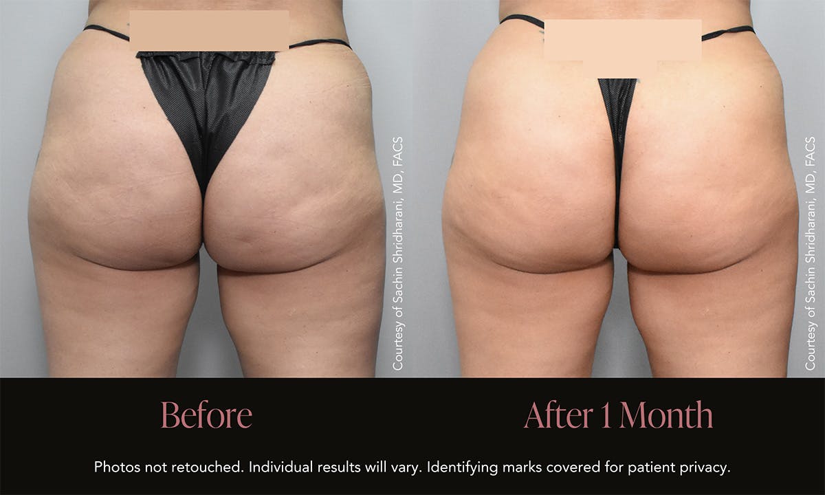 Avéli Before & After Gallery - Patient 904866 - Image 1