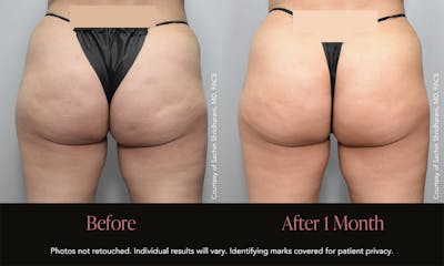 Avéli Before & After Gallery - Patient 904866 - Image 1