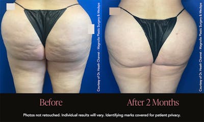 Avéli Before & After Gallery - Patient 376099 - Image 1