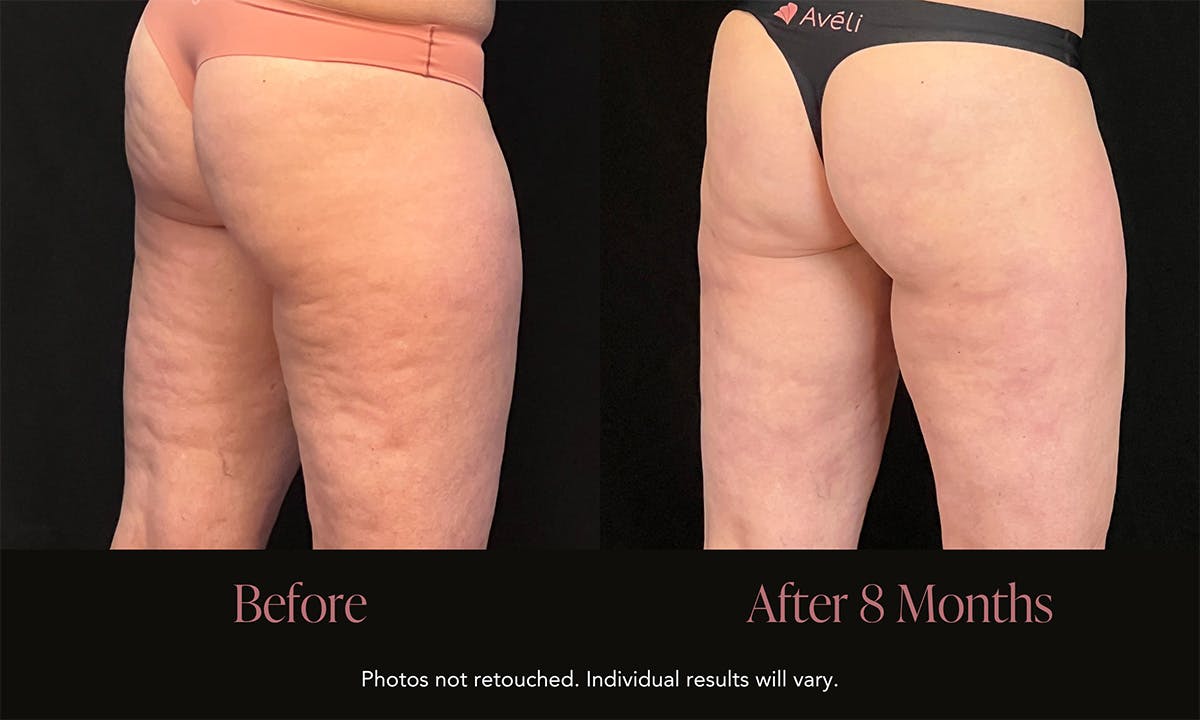 Avéli Before & After Gallery - Patient 107001 - Image 1