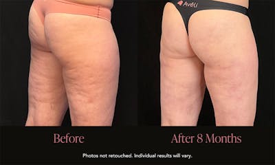 Avéli Before & After Gallery - Patient 107001 - Image 1