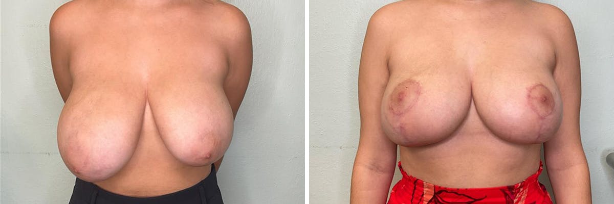 Breast Reduction Before & After Gallery - Patient 400425 - Image 1