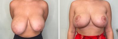 Breast Reduction Before & After Gallery - Patient 400425 - Image 1