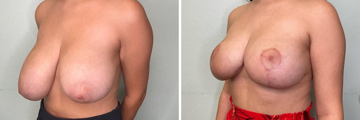 Breast Reduction Before & After Gallery - Patient 400425 - Image 2